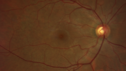 lymphoma1_caflo_07012019_01.png