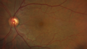 lymphoma1_caflo_07012019_02.png
