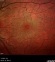 lymphoma1_caflo_07012019_04.jpg