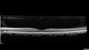 lymphoma1_caflo_07012019_11.jpg