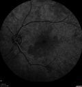 lymphoma1_caflo_07012019_16.jpg
