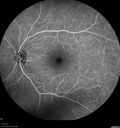 lymphoma1_caflo_07012019_22.jpg