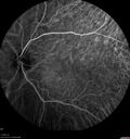 lymphoma1_caflo_07012019_27.jpg