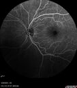 lymphoma2_caflo_032021_37.jpg