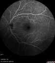 lymphoma2_caflo_032021_38.jpg