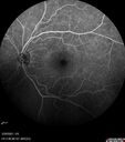 lymphoma2_caflo_032021_40.jpg