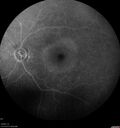 lymphoma2_caflo_032021_41.jpg