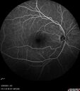 lymphoma2_caflo_032021_43.jpg