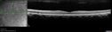 lymphoma3_caflo_092021_52.jpg