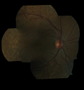 lymphoma_vija_120616_03.png