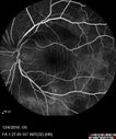 lymphoma_vija_120616_15.jpg