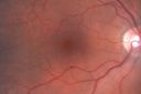 macroaneurysmbeforeandafter_heri02.jpg