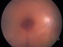 macroaneurysmbeforeandafter_heri04.jpg