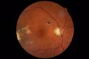 macular-damage-post-mh-surgery-ROKI_06201802.JPG