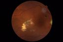 macular-damage-post-mh-surgery-ROKI_06201803.JPG