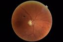 macular-damage-post-mh-surgery-ROKI_06201804.JPG