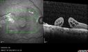 macular-damage-post-mh-surgery-ROKI_06201805.jpg
