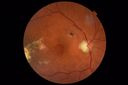 macular-damage-post-mh-surgery-ROKI_06201807.JPG