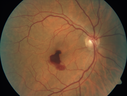 macular-heme-intraretinal_panad_102318_02.png