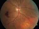 macular-heme-intraretinal_panad_102318_03.png