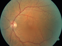 macular-heme-intraretinal_panad_102318_04.png