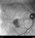 macular-heme-intraretinal_panad_102318_05.jpg