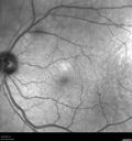 macular-heme-intraretinal_panad_102318_07.jpg