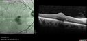 macular-heme-intraretinal_panad_102318_18.jpg