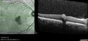 macular-heme-intraretinal_panad_102318_20.jpg