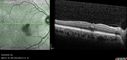 macular-heme-intraretinal_panad_102318_21.jpg