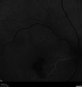 macular-heme-intraretinal_panad_102318_22.jpg