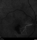 macular-heme-intraretinal_panad_102318_23.jpg