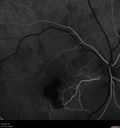 macular-heme-intraretinal_panad_102318_24.jpg