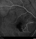 macular-heme-intraretinal_panad_102318_25.jpg