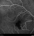 macular-heme-intraretinal_panad_102318_26.jpg