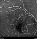 macular-heme-intraretinal_panad_102318_27.jpg