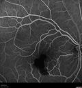 macular-heme-intraretinal_panad_102318_28.jpg