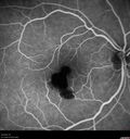 macular-heme-intraretinal_panad_102318_30.jpg