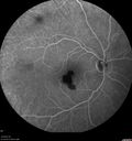 macular-heme-intraretinal_panad_102318_31.jpg