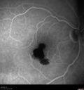 macular-heme-intraretinal_panad_102318_33.jpg