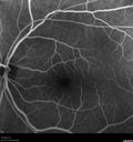 macular-heme-intraretinal_panad_102318_34.jpg