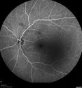 macular-heme-intraretinal_panad_102318_35~0.jpg