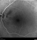 macular-heme-intraretinal_panad_102318_36~0.jpg