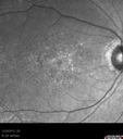 maculardystrophy_kewa_12201203.jpg