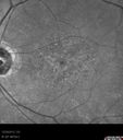maculardystrophy_kewa_12201204.jpg