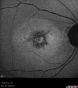 maculardystrophy_kewa_12201205.jpg
