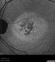 maculardystrophy_kewa_12201206.jpg