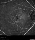 maculardystrophy_kewa_12201213.jpg