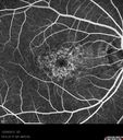 maculardystrophy_kewa_12201215.jpg