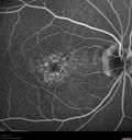 maculardystrophy_kewa_12201219.jpg